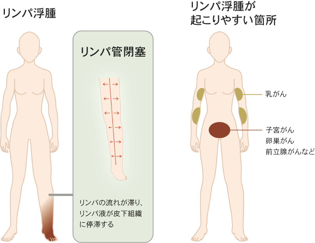 リンパ浮腫